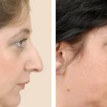 Understanding the Closed Nose Job: A Comprehensive Guide