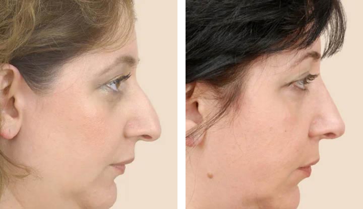 Understanding the Closed Nose Job: A Comprehensive Guide