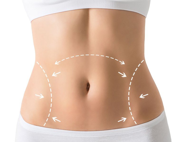 Understanding the Basics of Tummy Tuck Procedures in Washington DC